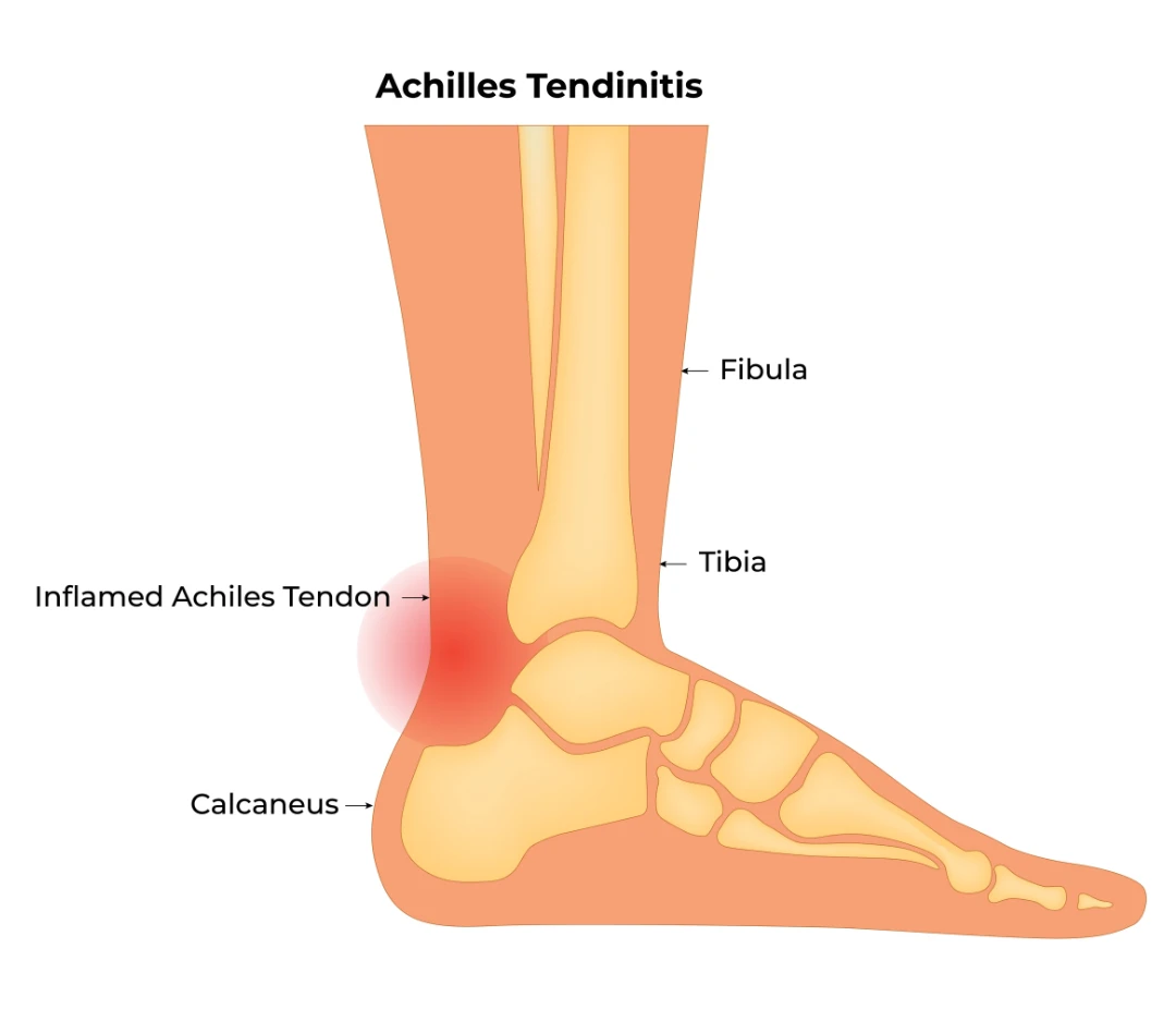 Achilles tendinitis singapore