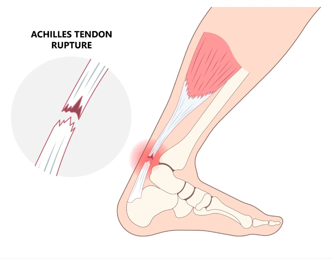 Achilles tendon rupture