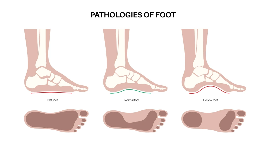 flat feet Singapore.