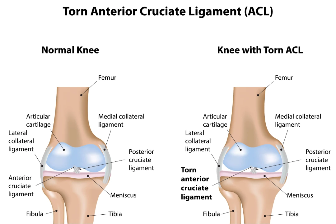 ACL Tear Singapore