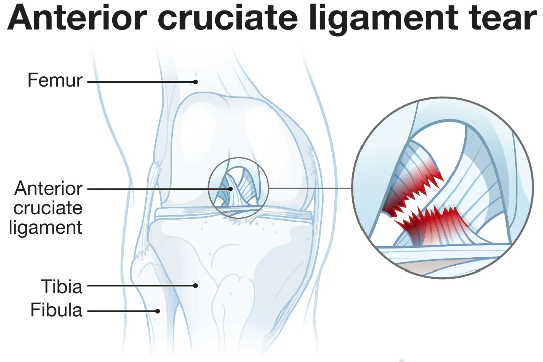 ACL Injury Singapore