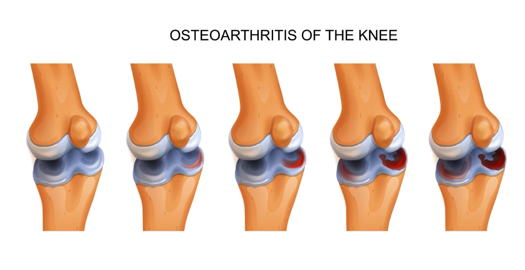 Osteoarthritis Singapore