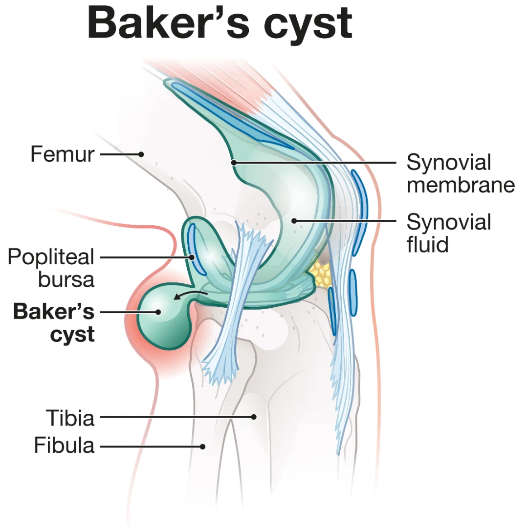 Baker’s(Popliteal) Cyst Singapore