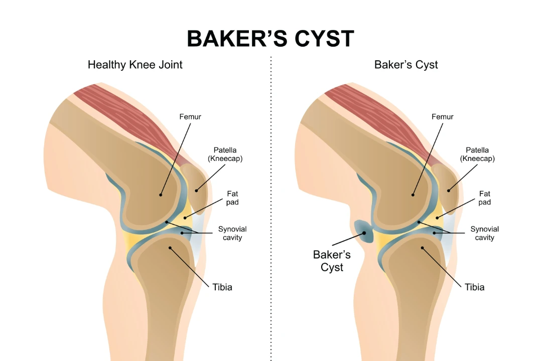 healthy knee joint vs. baker’s cyst