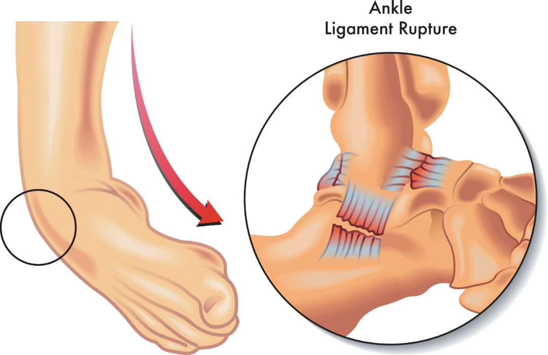 ligament tears singapore