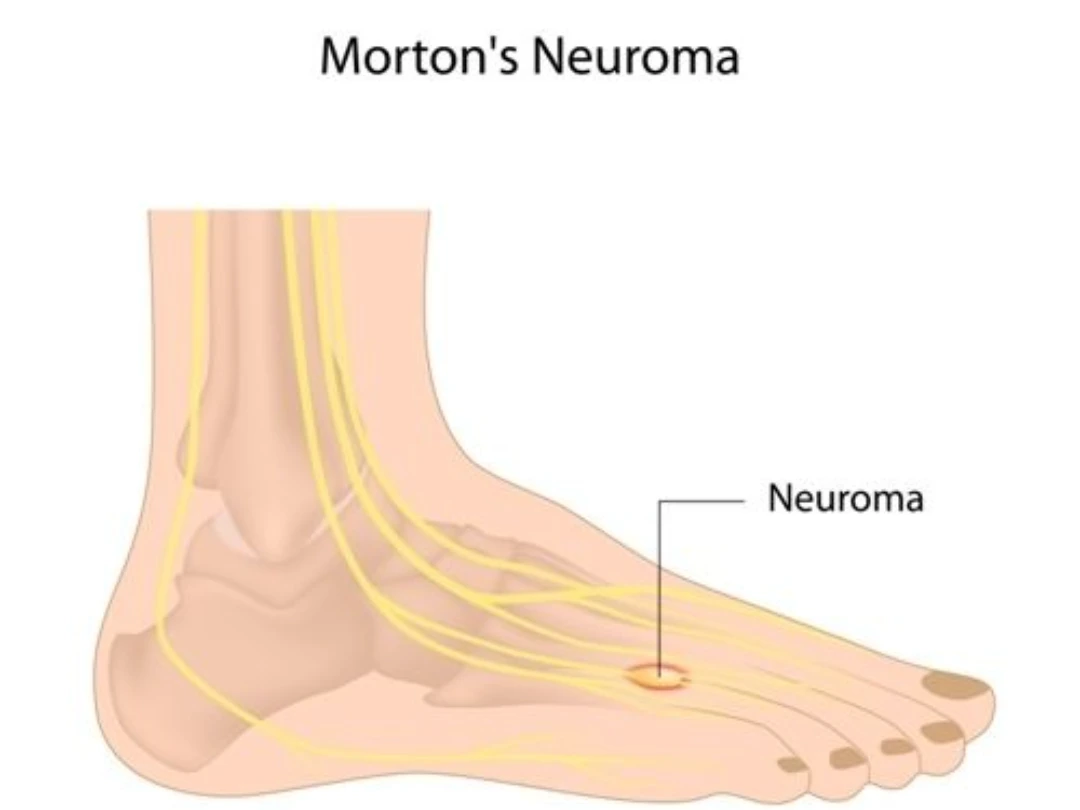 morton’s neuroma singapore