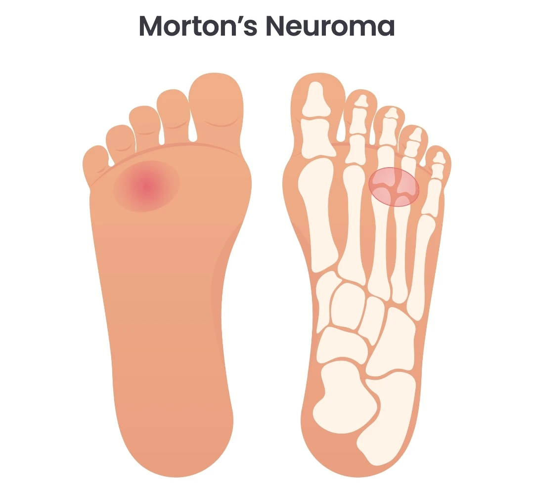 morton’s neuroma symptoms singapore