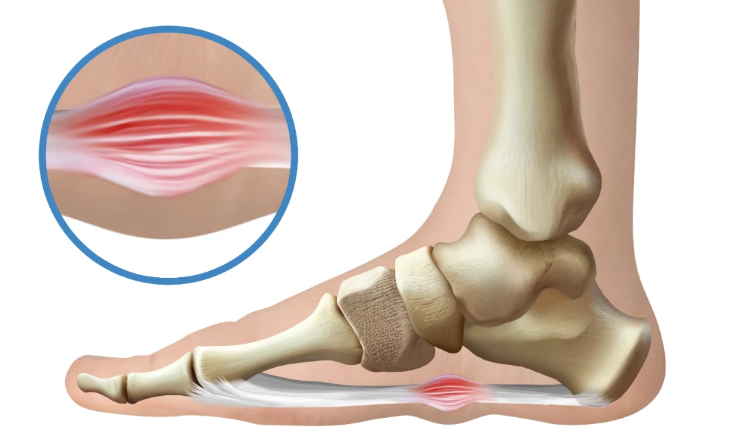 plantar fibroma Singapore.