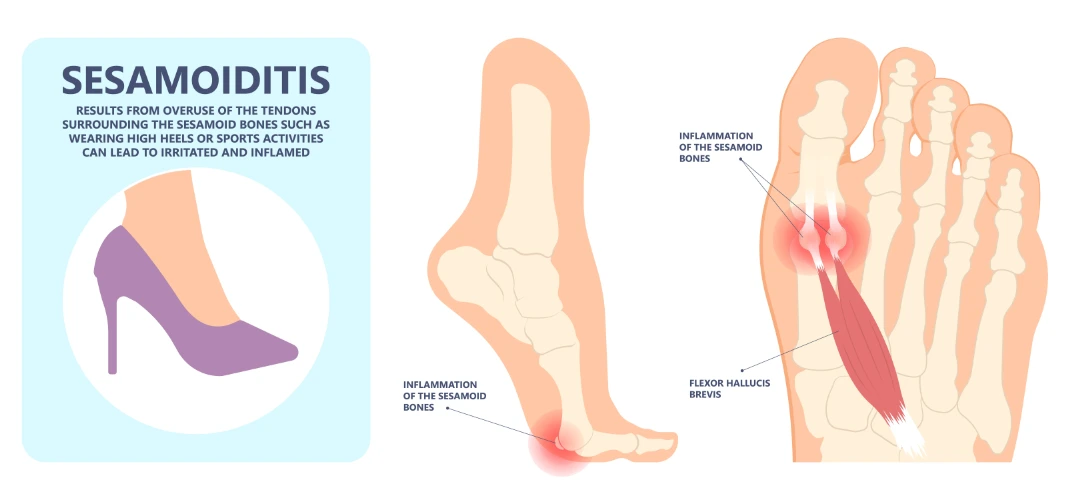 sesamoiditis Singapore.