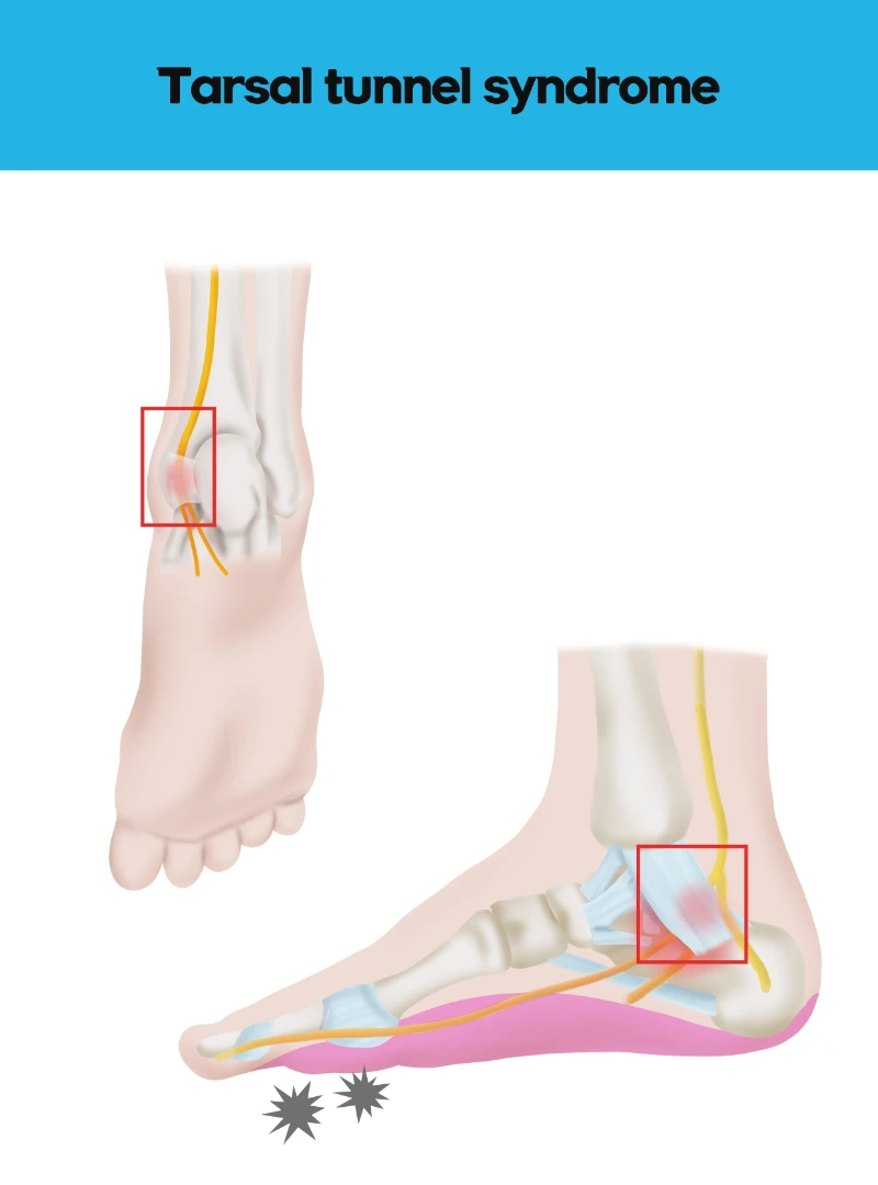 Tarsal Tunnel Syndrome Singapore