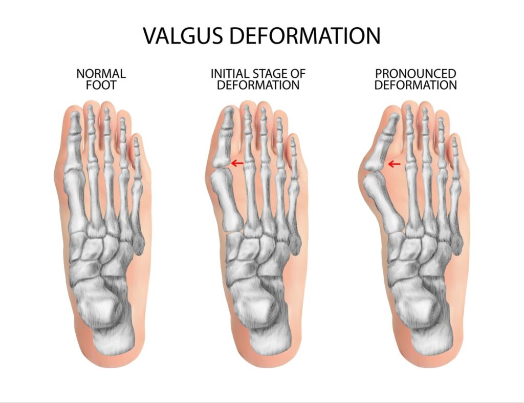 bunion surgery