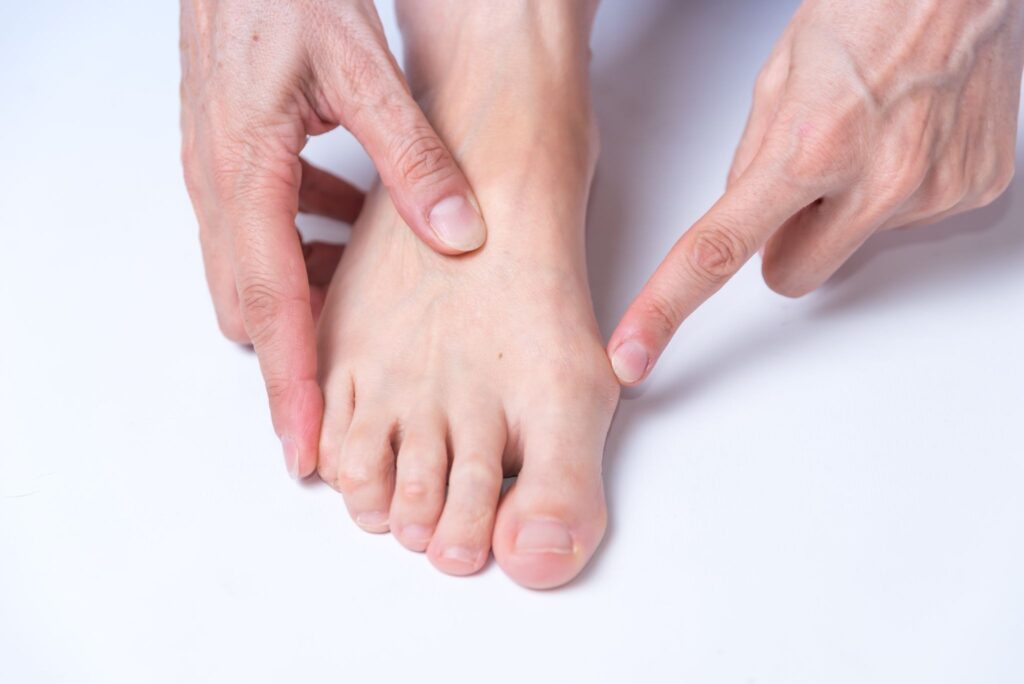 bunions