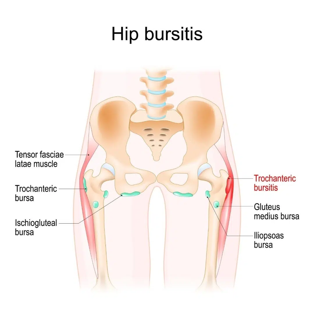 Cause of Hip Bursitis Singapore