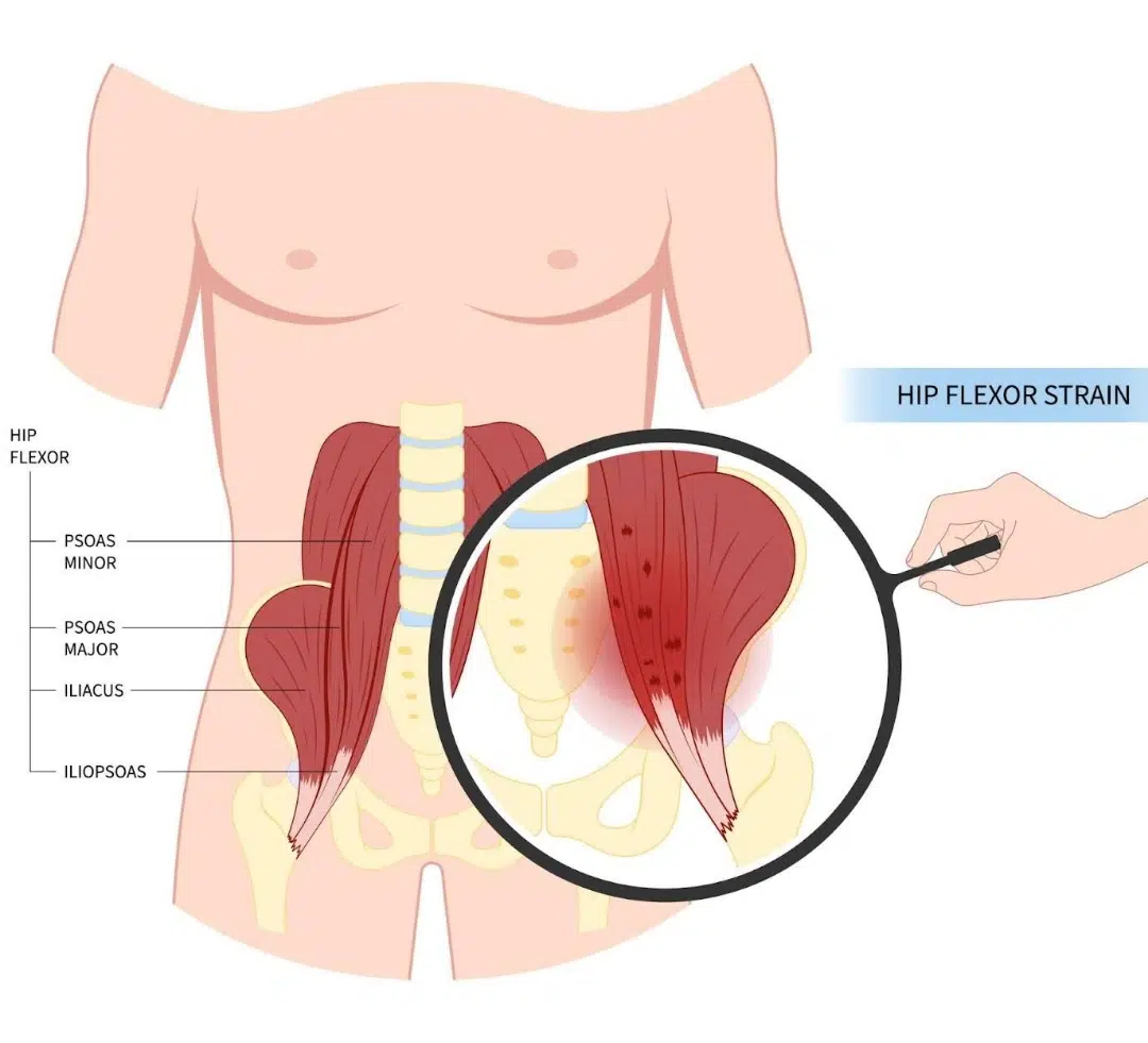 Hip Flexor Strain