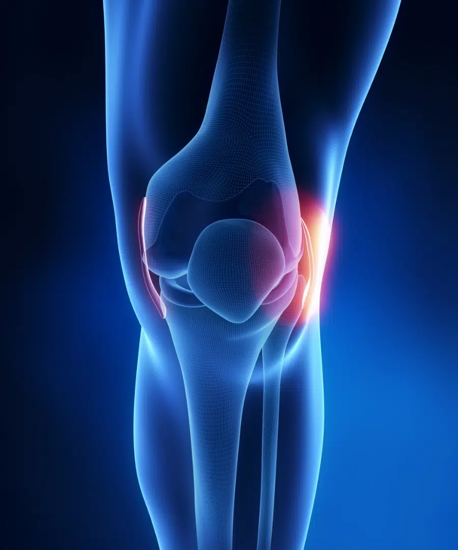 collateral ligament injuries.