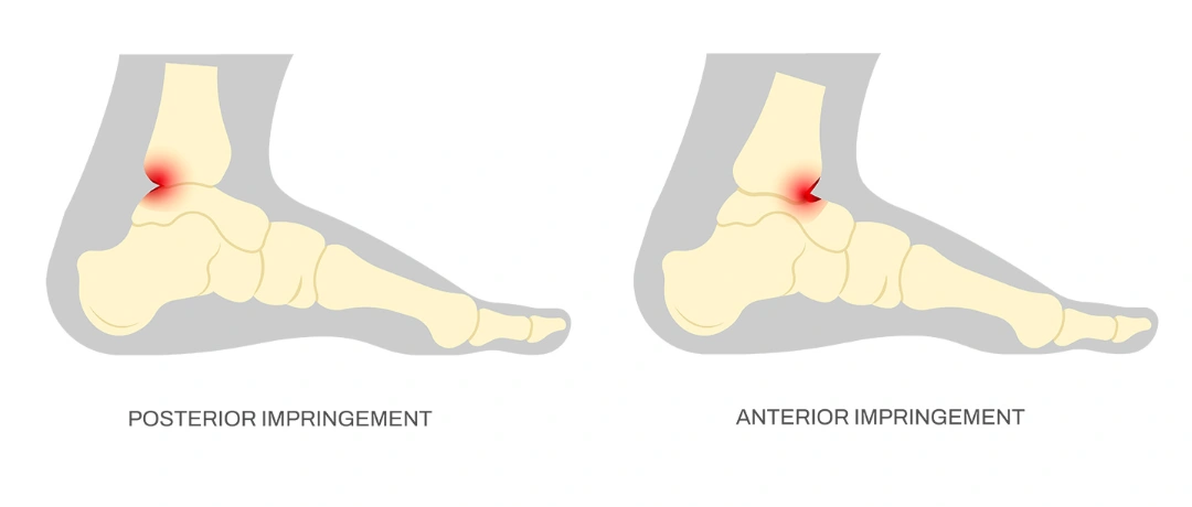 Anterior and Posterior Ankle Impingement Singapore