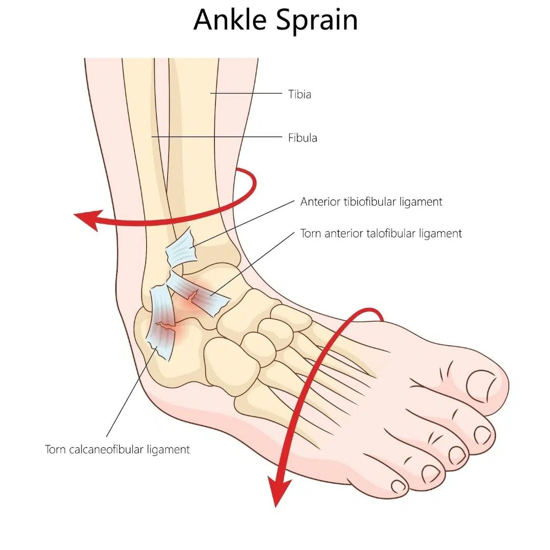 Ankle Instability Causes Singapore