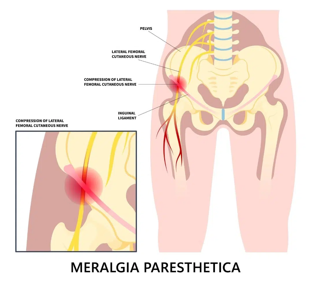 Meralgia Paraesthetica Singapore