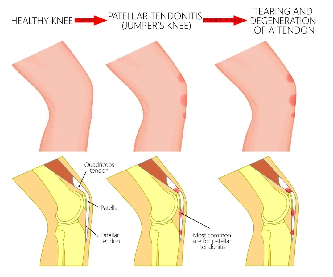 Patella Tendinopathy Singapore