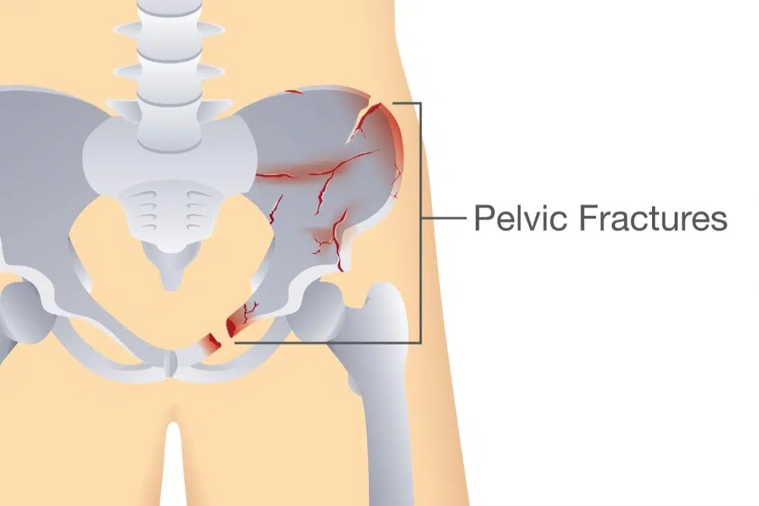 What Causes a Pelvic Fracture Singapore