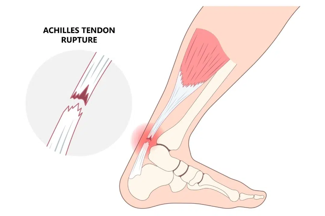 Cause of Achilles Tear Singapore