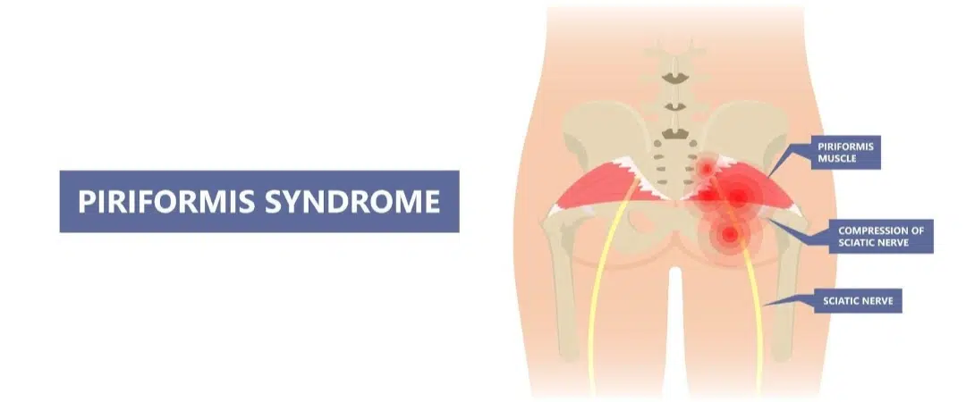 Cause of Piriformis Syndrome Singapore
