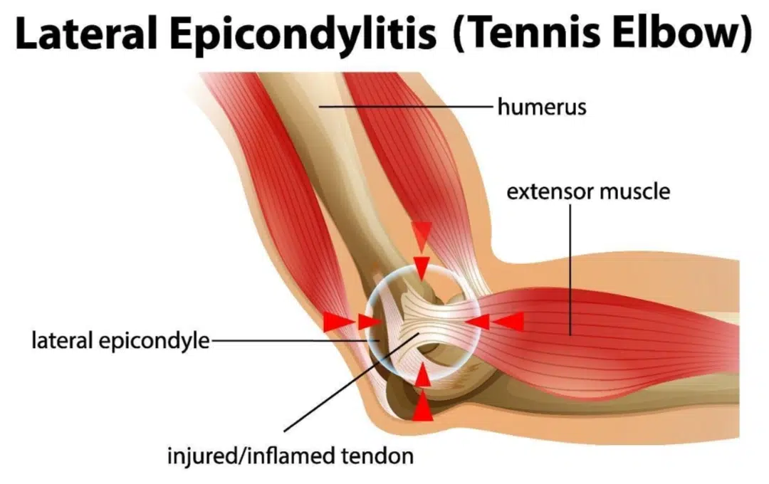 Tennis Elbow Singapore