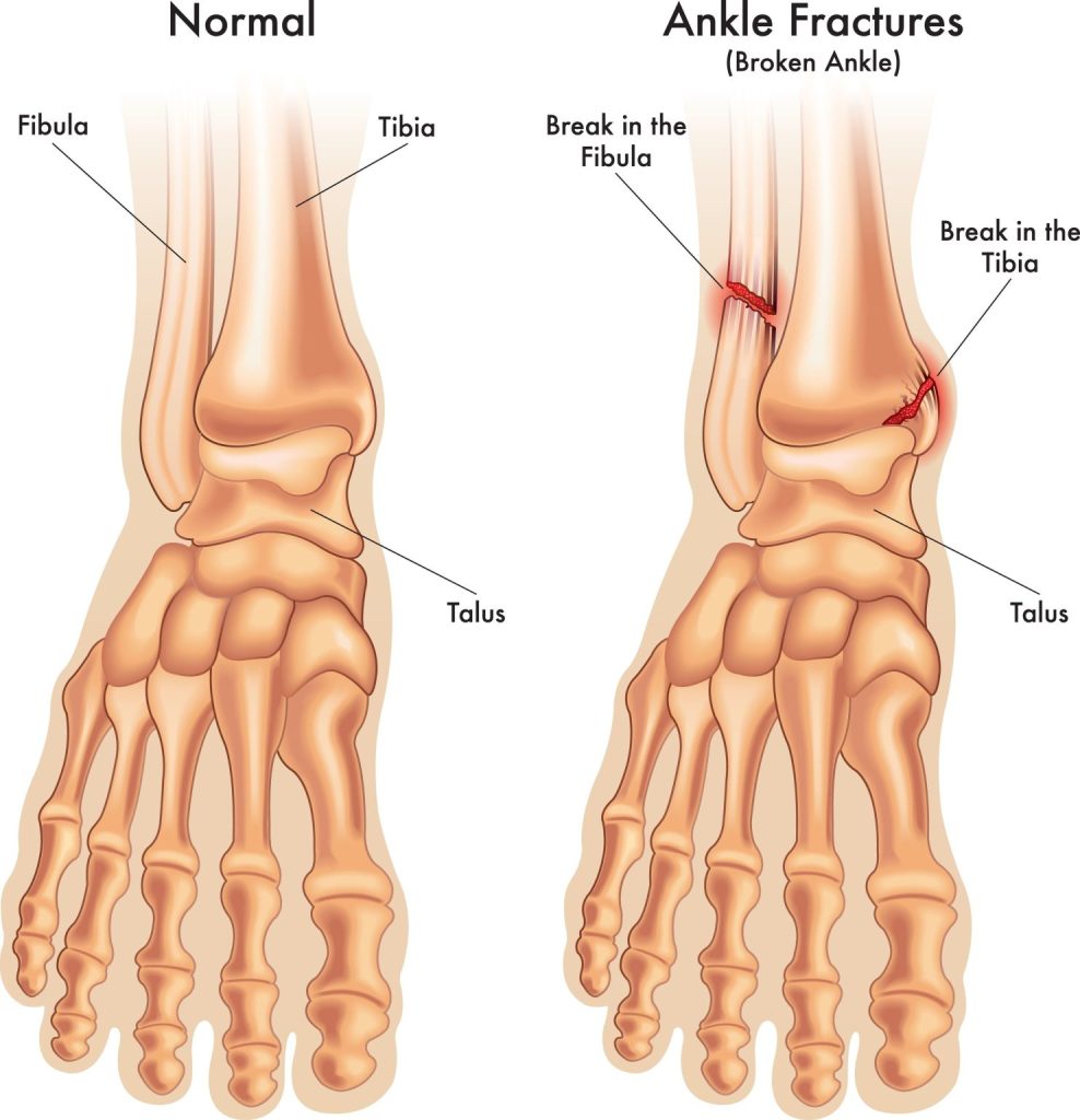 Foot and ankle fractures