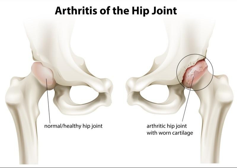 Inflammatory Arthritis of the Hip Singapore