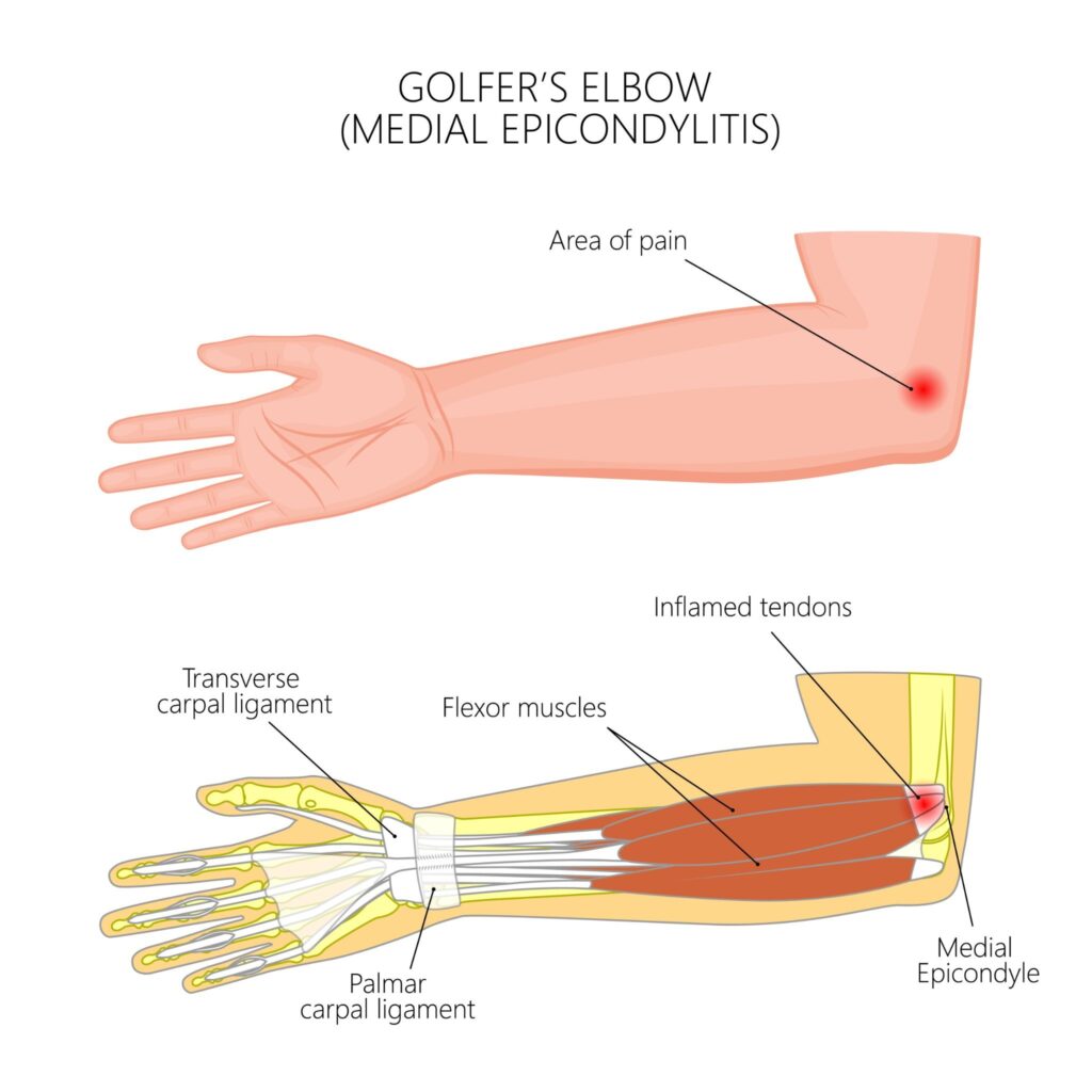 Cause of Golfer’s Elbow Singapore