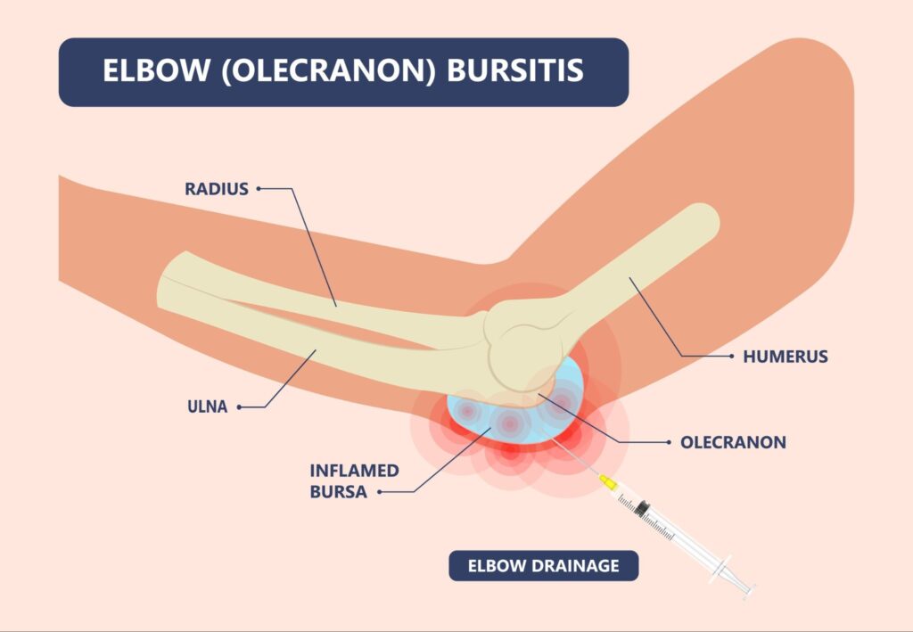 Drainage (Aspiration) for Olecranon Bursitis Singapore