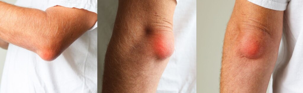 Olecranon Bursitis Singapore