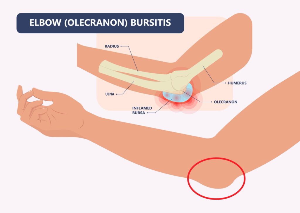 Elbow Bursitis Singapore