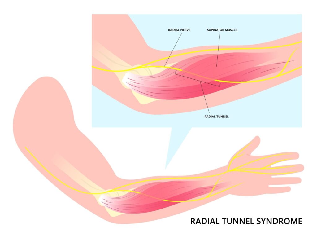 Radial Nerve Impingement Singapore