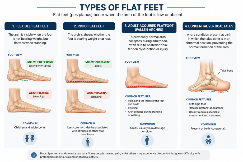 Diagram illustrating the different types of flat feet (pes planus), including flexible flat feet, rigid flat feet, adult-acquired flatfoot (fallen arches) and congenital vertical talus.