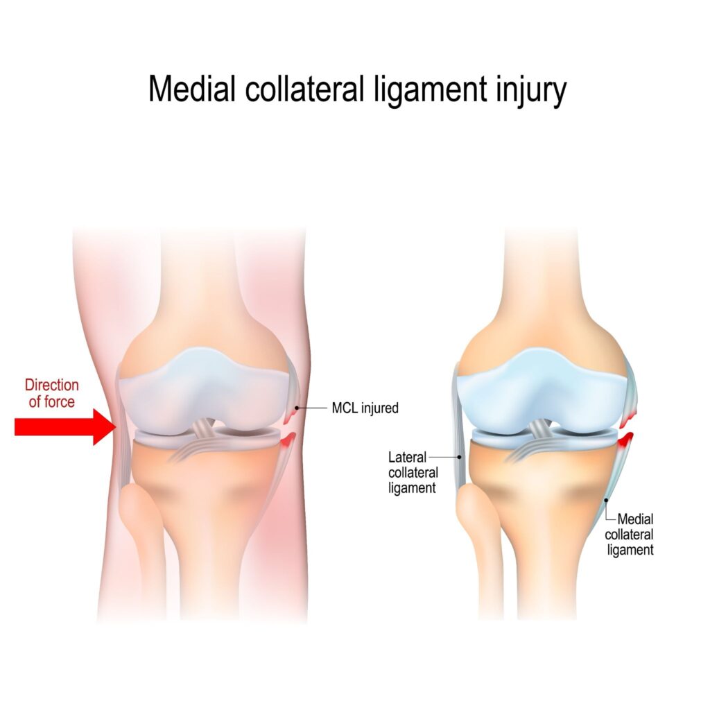 Medial Collateral Ligament (MCL) Injury Singapore