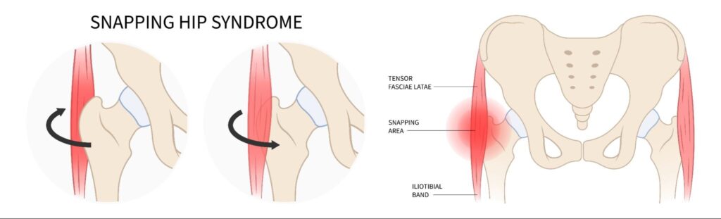 Types of Snapping Hip Syndrome Singapore