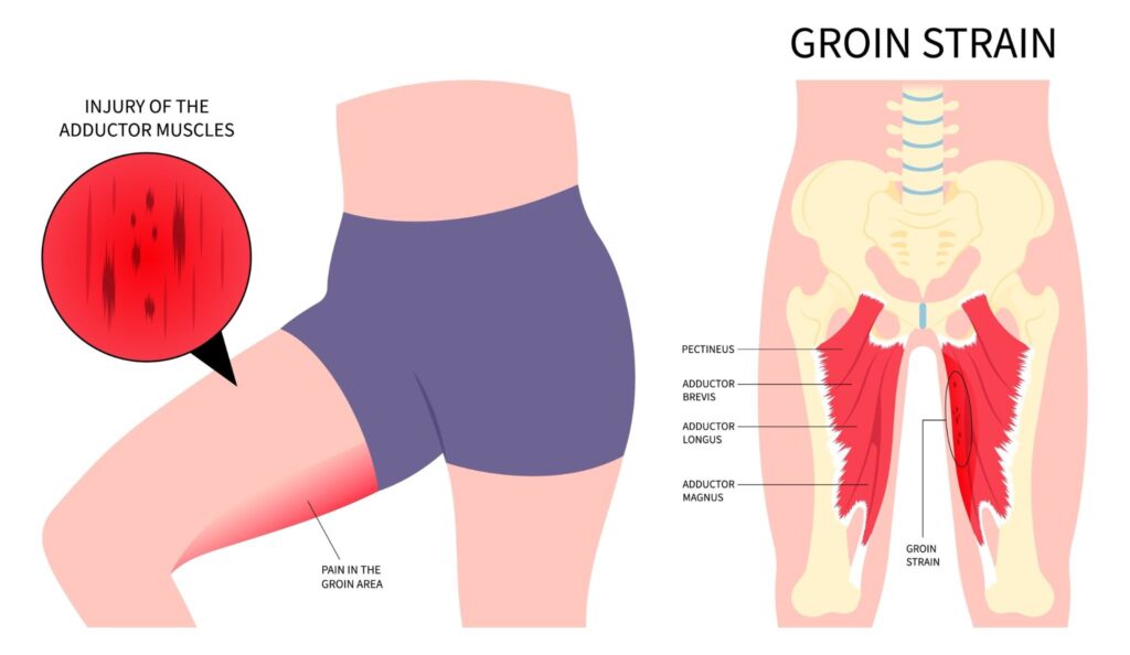 Sportsman's Groin Singapore